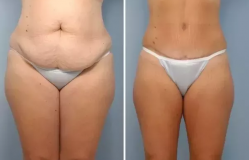 Liposuction